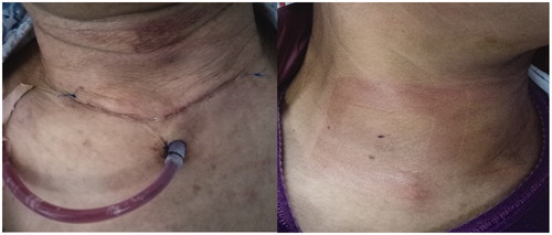 Figure 3. (a) A 61-year-old woman in the thyroidectomy group; the picture shows her early postoperative wound within a highly visible area; (b) The same patient as in Figures 1 and 2, the picture shows her cosmetic results of US-guided PMWA, where there is no obvious cervical scar in her neck.
