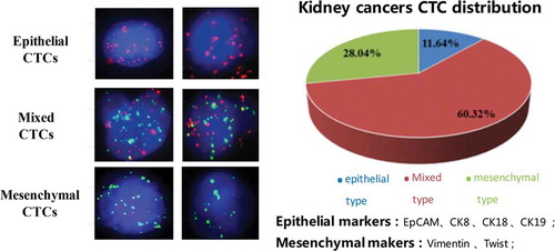Figure 1. Three types of CTCs in kidney cancers. Left panel showed the images of epithelial, mixed and mesenchymal CTCs. Epithelial CTCs presented only Alexa Fluor 594 (Red color) labeled epithelial markers (EpCAM and CK8/18/19), mesenchymal CTCs exhibited only Alexa Fluor 488 (Green color) labeled mesenchymal markers (Vimentin and Twist), and mixed CTCs having both epithelial and mesenchymal markers were stained with both green and red immunofluorescent dyes. Right panel showed the distribution of three CTCs types in kidney cancers.