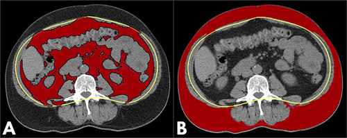 Figure 2 Fat-measurement technique in CT. After manual contour (yellow line) was placed on the abdominal wall skeletal muscles, automatic measurements of visceral adipose tissue (A, red area) and subcutaneous adipose tissue (B, red area) areas were performed with threshold values.