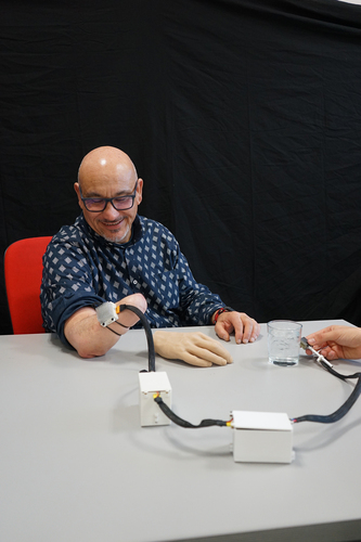 Figure 1. Transradial amputee testing the MiniTouch system. The MiniTouch’s thermode is placed on the residual arm of the participant. The experimenter places the sensor over different objects with various temperatures (here, a cup with cold water). The participant reports the thermal sensation in the phantom limb produced by this stimulus. During the tests, the participant was blindfolded. The image is printed with the permission of the participant and photographer.