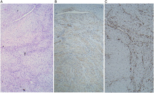 Figure 2. Microscopy specimens shows (A) a well circumscribed nodular neoplasms at 40× characterized by a distinctive biphasic growth pattern of immature appearing, plump, spindled tumor cells associated with hemangiopericytoma-like branching blood vessels. There is a clear architectural pattern of nodules and fascicles of variably hyalinized, myoid appearing cells. Mitotic figures are low. (B) Immunohistochemistry reveals tumor cells positive for smooth actin marker H-caldesmon and (C) negative for desmin.