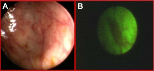 Figure 4 Tubular adenoma in white light endoscopy (A) and autofluorescence (B) imaging.