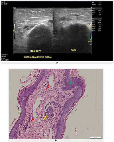 Figure 2 Histopathology and imaging. (A) Doppler ultrasonography. Multiple hypoechoic lesions on left leg showing avascularization indicate lymphedema (yellow box). (B) Histopathological results. Hyperkeratosis of the epidermis (green arrow), loss of sweat glands (yellow arrow), and dilated lymph vessels (red arrows) supported diagnosis of ENV.