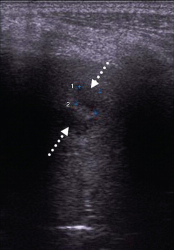 Figure 3. Two microabscesses (dotted arrows) with the greatest diameter of 7 mm.