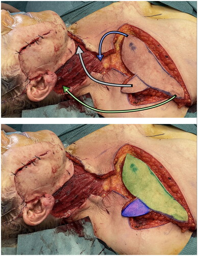 Figure 2. In the first picture the shark flap was harvested and just before insetting phase. Arrows are showing the trasposition movements from donor to recipient site. In the second one the two main vascular area were highlighted – green: standard IMAP flap; blu: random area base on connections between TAP and IMAP.