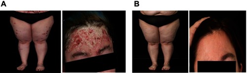 Figure 1 Case 1: psoriatic lesions on the legs and forehead (A) before and (B) after 14 months of brodalumab treatment.
