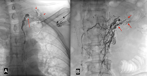 Figure 3 Intranodal lymphangiography of a 54-year-old female patient with chyluria for 2 months. (A) Obstruction at the TD-venous junction (long arrow), leading to collateral lymphatic circulation at the neck (short arrows). (B) Dilated lymphatic vessel at the lumbar level and a uro-lymphatic fistula observed in the left kidney (arrows).