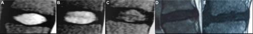 Figure 4 Modic changes were characterized on magnetic resonance imaging.