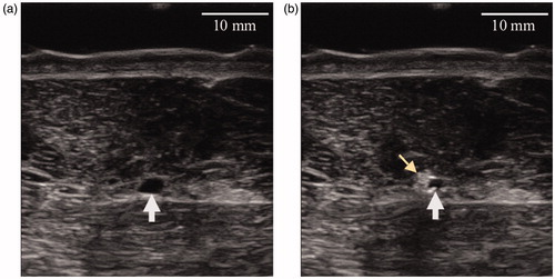 Figure 7. Ultrasound images of the lateral saphenous vein (pointed by a white arrow) of a sheep before exposure (a) and immediately after exposure (b).The exposed vein has a reduced lumen and a hyper-echoic mark (pointed by a yellow arrowhead) is visible.
