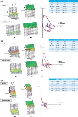 Figure 1. Colored 3D images of IOS and pulmonary functions of typical cases with CVA, BA, and ACO. A case of CVA (a), BA (b), and ACO (c). In typical cases of CVA, an improvement in airway resistance after SABA inhalation was noted, and the spirometry shows negligible change before and after SABA inhalation. In cases of typical BA, the IOS waveform shows stronger airway resistance, indicating improvement after SABA inhalation. The recovery of FEV1 in BA patients is ≥ 200 ml and ≥ 12%, and a significant improvement of flow–volume curves is also noted. ACO is diagnostically important when the FEV1/FVC is < 70% after SABA inhalation and has airway reversibility. The IOS waveform of typical ACO is characterized by an increase in the downward waveform of the reactance component expressed by Xrs in addition to an increase in the airway resistance of Rrs.