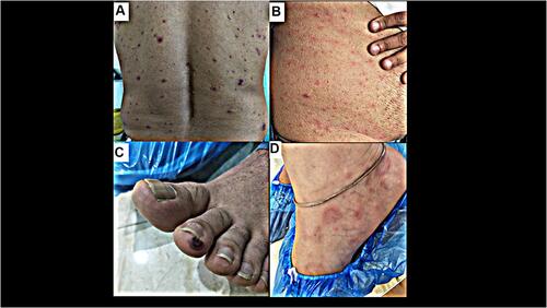 Figure 5 Cutaneous manifestations of Long-COVID-19 in different patients after varying duration of initial diagnosis: (A) hemorrhagic guttate psoriatic lesions on the back in previously known psoriasis patient (5 weeks after symptom onset) (B) retiform maculopapular itchy rash on the trunk (10 weeks after disease onset) (C) persistent, asymptomatic COVID toe (12 weeks after initial diagnosis) (D) erythema multiforme lesions on the right foot (6 weeks following symptom onset).