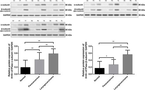 Figure 3 Expression levels of the H+/K+-ATPase α- and β-subunit proteins in representative normal laryngeal tissues and laryngeal carcinomas as revealed by Western blotting.