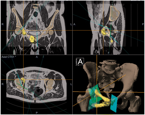 Figure 2. Surgical planning of the resection planes in the OrthoMap Oncology Module with tumor coloration on the fused MRI/CT image. Patient information is digitally edited out in the bottom left panel. The bottom right panel shows a 3D rendering of the pelvic bone and the resection planes.