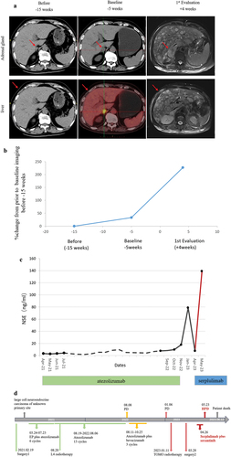 Figure 1. Case study of a LCNEC patient with HPD during immunotherapy.