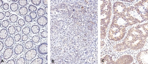 Figure 2 Immunohistochemical staining for proprotein convertase subtilisin/kexin-type 1 (PCSK1) in rectal cancers. The non-neoplastic colonic mucosa (A) reveals no expression of PCSK1 as compared with rectal cancers with low expression (B) and high expression (C) of PCSK1 in pretreatment specimens, respectively.