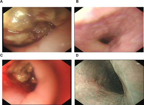 Figure 3 Gastroscopy during therapy. (A) SCCE relapse after six courses of IP chemotherapy. (B) Significant esophageal wall shrinkage after 1 month of anlotinib monotherapy.(C) Esophageal wall re-thickening following 3 months of anlotinib monotherapy. (D) Lugo’s iodine staining of the esophageal wall 3 months after treatment with anlotinib in combination with toripalimab.