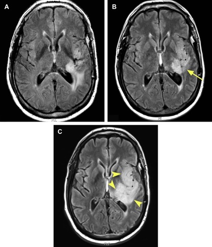 Figure 2 Axial FLAIR T2 (TR:500, TI:2500, TE:125) weighted MRI images for case 1 taken at approximately the same levels in the area of the mid-thalamus.