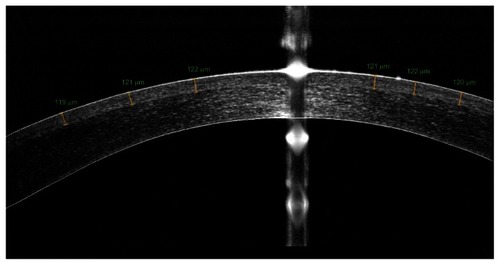 Figure 2 Measurement of flap thickness from the high-resolution meridional scan provided by the anterior-segment optical coherence tomography system.