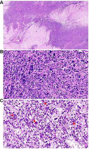 Figure 4 Classic morphological characteristics of uterine leiomyosarcoma (LMS). (A) The tumor displays coagulative tumor cell necrosis. (B) Tumor cells show moderate-to-severe cytologic atypia. (C) Tumor cells show high active mitosis (red arrows).
