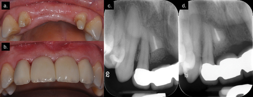 Figure 4. (a) Maintenance of alveolar ridge; (b) Final FPD delivery; (c) 7-month recall radiograph (20 months post-initial surgery); (d) 19-month recall radiograph (32 months post-initial surgery).