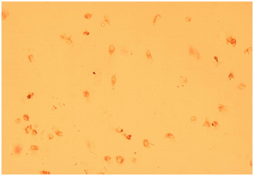 Figure 2. The figure of HUVEC cells. HUVEC were stimulated with factor VIII, and the related antigen-antibody complexes had red-brown precipitate in the cytoplasm (× 40 magnification).