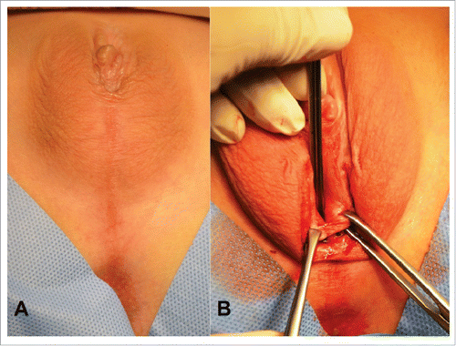 FIGURE 4. Androgen insensitivity syndrome, incomplete form. (A) External genital view after clitororeduction. The urogenital sinus opens near of the base clitoris. (B) The Y-shaped introitoplasty. The vertical cutting of the urogenital sinus opens the orificium. The internal mucosa was turned outwards, and located edge-to-edge with the skin incision before suturing. The widely shaped vaginal introitus was formed.