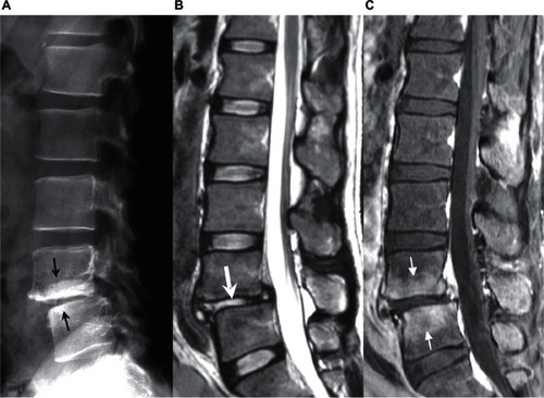 Figure 2 Images on admission. A) Plain x-ray. Although osteosclerosis of the L4 and L5 vertebral bodies was noted (small black arrow), no apparent bone destruction or spur formation was seen in the anterior corner of the vertebral bodies. B) Plain T2-weighted MRI. Signal intensity of the L4/L5 intervertebral disc had apparently changed in comparison with that shown in Figure 1 (thick white arrow). C) Gadolinium-enhanced fat-suppressed T1-weighted MRI. The L4 and L5 vertebral bodies adjacent to the L4/L5 intervertebral disc space were enhanced with gadolinium (small white arrow).