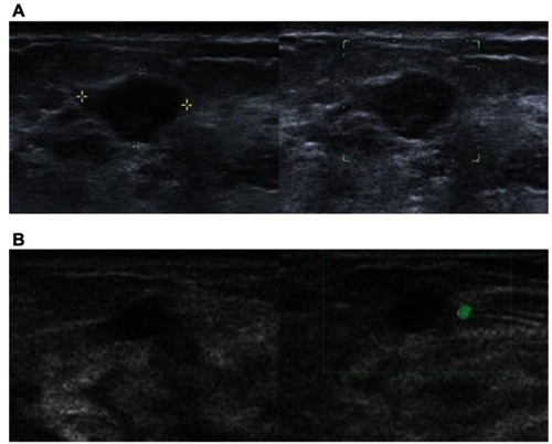 Figure 1 (A) A solid hypo-echoic breast lesion categorized as BI-RADS-US 4A in real-time scanning and BI-RADS-US 3 in static image evaluation. The pathologic diagnosis was IDC. (B) A solid hypo-echoic breast lesion categorized as BI-RADS-US 3 in real-time scanning and BI-RADS-US 4A in static image evaluation. The pathologic diagnosis was DCIS.Abbreviations: IDC, invasive ductal carcinoma; DCIS, ductal carcinoma in situ.