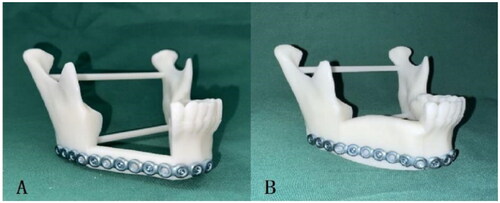 Figure 3. Stereolithographic models of mandible reconstructed with free fibula flap (A) or deep circumflex iliac artery flap (B) fixed using manually prebent conventional surgical plates.
