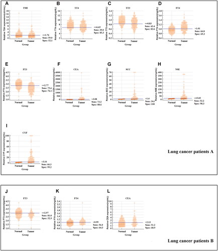 Figure 4. The sensitivity and specificity of markers to differentiate lung cancer patients with different TNM stage from healthy subjects. (A) The sensitivity, specificity and cut-off value of TSH concentration in the lung cancer patients A group. (B) The sensitivity, specificity and cut-off value of TT4 concentration in the lung cancer patients A group. (C) The sensitivity, specificity and cut-off value of TT3 concentration in the lung cancer patients A group. (D) The sensitivity, specificity and cut-off value of FT4 concentration in the lung cancer patients A group. (E) The sensitivity, specificity and cut-off value of FT3 concentration in the lung cancer patients A group. (F) The sensitivity, specificity and cut-off value of CEA concentration in the lung cancer patients A group. (G) The sensitivity, specificity and cut-off value of SCC concentration in the lung cancer patients A group. (H) The sensitivity, specificity and cut-off value of NSE concentration in the lung cancer patients A group. (I) The sensitivity, specificity and cut-off value of CYF concentration in the lung cancer patients A group. (J) The sensitivity, specificity and cut-off value of FT3 concentration in the lung cancer patients B group. (K) The sensitivity, specificity and cut-off value of FT4 concentration in the lung cancer patients B group. (L) The sensitivity, specificity and cut-off value of CEA concentration in the lung cancer patients B group.