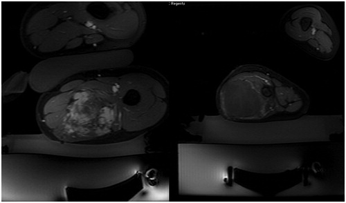 Figure 1. (A) Axial post-contrast fat saturated images following MRgFUS of desmoid tumors of the thigh in two separate patients. In the image on the left, there is persistent patchy enhancement following the treatment, consistent with a residual viable tumor. (B) In contrast, the image on the right from a different patient demonstrates only a thin peripheral rim of enhancement, compatible with a successful large volume ablation (>95%).