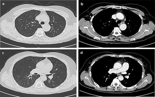 Figure 3 After more than 1 month of the treatment, the follow-up chest CT exhibited reduced mediastinal (a and b) and hilar (c and d) lymph nodes relative to that before the treatment.