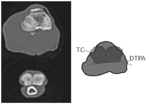 Figure 2. Measurement of tibial torsion on CT. TC: transcondylar axis; DTPA: distal tibial posterior axis.