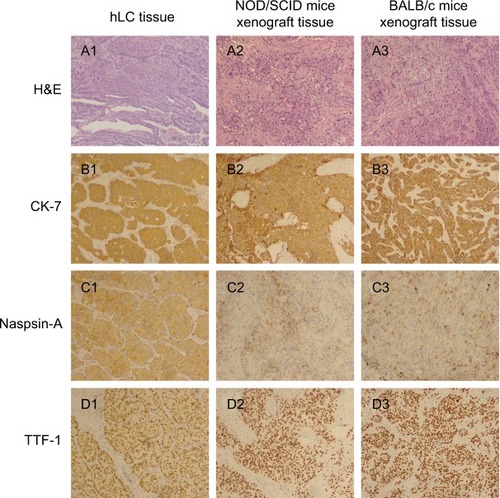 Figure 1 Comparison of building PDX models in NOD/SCID mice and BABL/c mice with the corresponding adenocarcinoma patient.Notes: (A1) H&E staining of human lung cancer tissue; (A2) H&E staining of NOD/SCID mice xenograft tissue; (A3) H&E staining of BALB/c mice xenograft tissue; (B1) CK-7 staining of human lung cancer tissue; (B2) CK-7 staining of NOD/SCID mice xenograft tissue; (B3) CK-7 staining of BALB/c mice xenograft tissue; (C1) Naspin A staining of human lung cancer tissue; (C2) Naspin A staining of NOD/SCID mice xenograft tissue; (C3) Naspin A staining of BALB/c mice xenograft tissue; (D1) TTF-1 staining of human lung cancer tissue; (D2) TTF-1 staining of NOD/SCID mice xenograft tissue; (D3) TTF-1 staining of BALB/c mice xenograft tissue. Magnification ×100.Abbreviations: hLC, human lung cancer; PDX, patient-derived tumor xenografts.