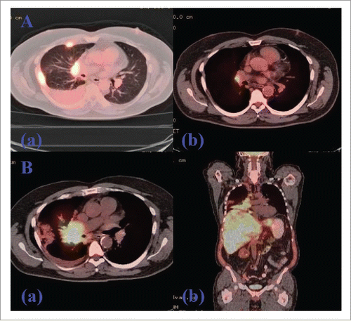 Figure 3. PET/CT of Chest Showing Initial Response with Subsequent Progression Following TKI-Exposure (afatinib). (A). PET/CT showing interval response after 4 months treatment of afatinib. (a). FDG-avid thoracic LAD and right pleural disease before the initiation of afatinib. (b). Marked improvement of lung cancer on PET/CT showing a solitary residual right hilar LN after four months of TKI treatment. (B). PET/CT showing progression after 10 months treatment of afatinib. (a). Axial view showing a marked progression of metastatic lung disease with diffuse hepatic and skeletal involvement along with the progression of right perihilar mass. (b). Coronal view showing the same progression following post-TKI resistance.