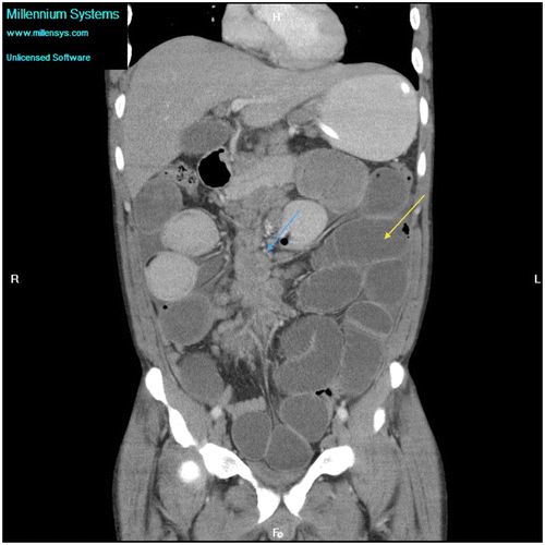 Figure 6c: Coronal CT showing gross small bowel dilatation (yellow arrow) with extensive mesenteric adenopathy (blue arrow) secondary to tuberculosis