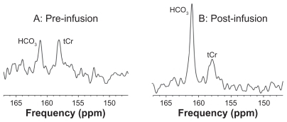 Figure 2 Typical spectra (147–167 ppm region) of 13C MRS in an AD subject at baseline (A) and at 1 hour after start of infusion (B).