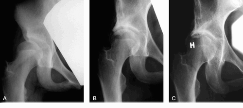 Figure 3. Radiographs of a girl with a Spitzy shelf operation at the age of 12 years. Panel A shows acetabular dysplasia of the right hip before the shelf procedure was performed. Panel B, taken at the age of 17 years, indicates that the operation has given an adequate acetabular roof. Panel C shows no signs of osteoarthrosis at the age of 33 years.