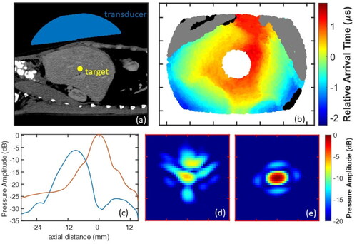 Figure 2. Soft tissue histotripsy phase aberration. (a) a histotripsy transducer (blue) was simulated focusing through the human abdomen at a target (yellow) in the liver. (b) Simulated arrival time differences to the target projected onto the transducer aperture. Portions blocked by rib and bowel/lung are shown in gray and black, respectively. (c) Axial profiles of the focal pressure amplitude, with (orange) and without (blue) aberration correction. (d), (e) 12-mm × 12-mm transverse cross sections of the focal pressure amplitude, without (d) and with (e) aberration correction (this figure is adapted from Yeats et al. [Citation67]).