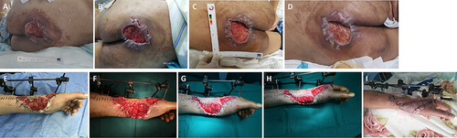 Figure 3 Presentation Pictures of typical cases of control group. A patient was admitted with a sacral caudal pressure sore infected by MRSA (A-D). (A) A round wound was placed at the sacrocaudal end, which infected by MRSA. (B) Secretions were still visible on the wound 4 days after treatment. (C) After 7 days of treatment, the granulation tissue of the wound increased significantly and there was still a little secretion. (D) After 12 days treatment, There was still a little necrotic tissue and secretions on the wound. A patient was suffered skin and soft tissue defect with MRSA infection at left arm (E-I). (E) There are necrotic tissue and secretions in the wound. Fig F, Wound necrosis and secretions were cleared by debridement. (G) After 5 days of treatment, wound infection was relieved and secretions decreased. (H) After 10 days of treatment, secretions were significantly decreased and granulation grew well. (I) After 14 day of treatment, wound were covered by skin graft.