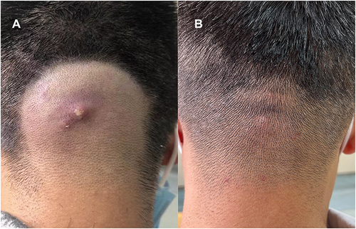 Figure 4 Patient 4: (A) lesion before fire needle treatment. (B) lesion after 14 days of fire needle treatment.