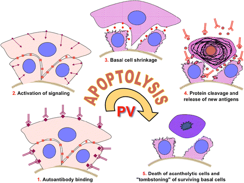 Figure 8.  Hypothetical scheme of keratinocyte apoptolysis in PV. Step 1: apoptolysis is triggered by binding of autoantibodies to the PV antigens capable of transducing apopotolytic signals from the keratinocyte plasma membrane, such as PERP and AChRs. Step 2: outside-in signaling from ligated antigens launches the cell death cascades. Step 3: collapse and retraction of the TFs cleaved by executioner caspases and dissociation of interdesmosomal adhesion complexes caused by phosphorylation of adhesion molecules result in basal cell shrinkage, most of desmosomes remain intact. Step 4: massive cleavage of cellular proteins by activated cell death enzymes leads to collapse of the cytoskeleton and tearing off desmosomes from the CM with subsequent production of scavenging (i.e. secondary) autoantibodies mainly to sloughed adhesion molecules. Step 5: suprabasal acantholytic cells die rendering a tombstone appearance to surviving basal cells. Modified from Ref. Citation[1].