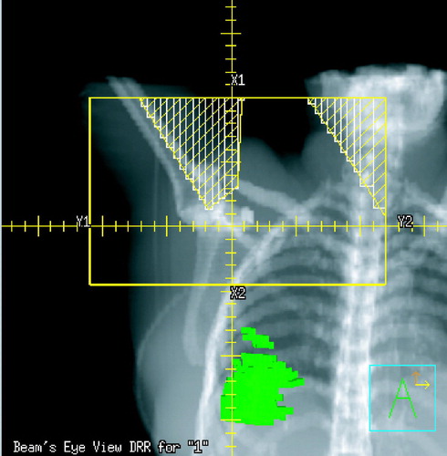 Figure 2A.  Frontal image (BEV) depicting the position of the frontal photon beam covering the supraclavicular fossa and axilla. Green areas represent regions with post-RT density changes.