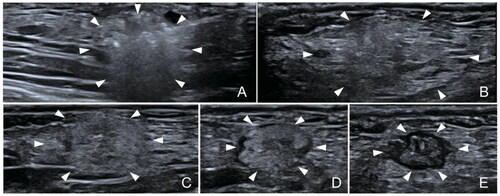 Figure 3. Ultrasound images of the ablated area at different times after the MWA. (A) In the MWA (B) 1 week after the MWA (C) 2 weeks after the MWA (D) 4 weeks after the MWA (E) 3 months after the MWA. The white arrows point to the ablated area.