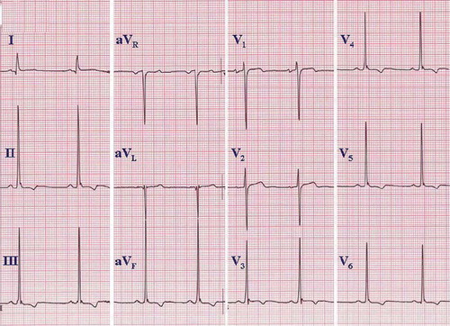 Figure 3. ECG from a healthy young athlete. The pattern of an ‘athlete heart’ may mimic the ECG changes seen in HCM. QRS voltage criteria for LVH based on the Sokolow–Lyon criteria, ST segment abnormalities similar to strain pattern, and inversion of terminal P wave in lead V1 may all be present. An echocardiogram may be needed to exclude the possibility of HCM. If uncertain, serial echocardiograms may be repeated over time, because the anatomic pattern of HCM may lag behind the ECG changes. Paper speed 25 mm/s, gain 10 mm/mV.