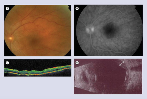 Figure 3. A ‘pre-exudative’ stage in a patient with early acute Vogt–Koyanagi–Harada disease.(A) Fundus photograph of left eye shows optic disc edema and retinal and choroidal folds. There is no evident exudative retinal detachment. (B) Early-phase fluorescein angiography shows hypofluorescent striae and optic disc hyperfluorescence. (C) Optical coherence tomography of the same eye shows multifocal folds of the retinal pigment epithelium and Bruch’s membrane. (D) 10-MHz ultrasonography shows diffuse medium reflective choroidal thickening (white arrow).