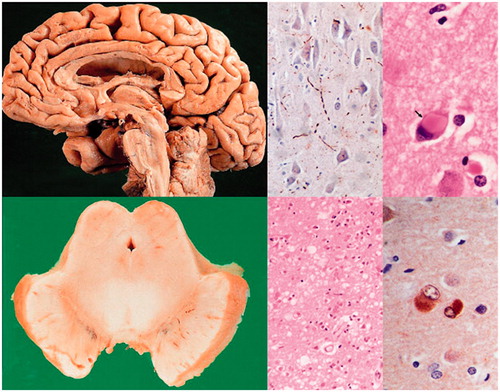Figure 4. Dementia with Lewy bodies. Diffuse brain atrophy (upper left), degeneration of substantia nigra (lower left), multiple Lewy bodies and Lewy neurites in brainstem and cerebral cortex (right).