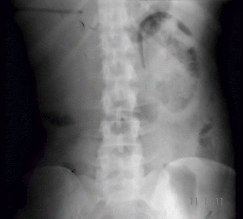 Figure 1. X-ray KUB showing gas shadows streaking the renal parenchyma bilaterally.