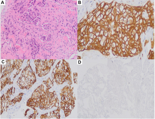 Figure 5 (A–D) Biopsy of the upper lobe of the left lung indicated infiltration of lung adenocarcinoma. (A) HE staining, ×200; (B) CK (+), ×400; (C) CK7 (+), ×200; (D) P40 (+) ×100.