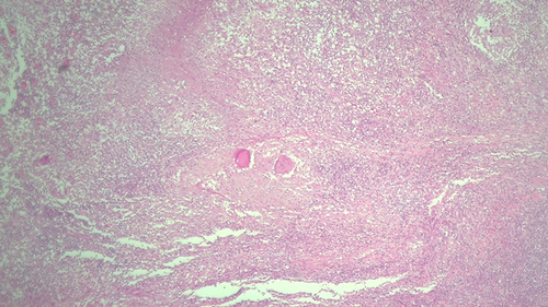 Figure 3 Microscopic examination revealing numerous caseous and non-caseous epithelioid and giant cell granulomas. (hematoxylin-eosin, 40x).